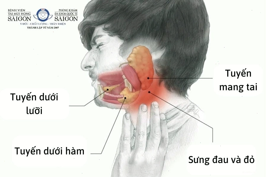 Triệu chứng viêm tuyến nước bọt gây tăng tiết