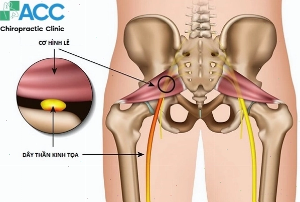 Tư thế đứng gây tê chân