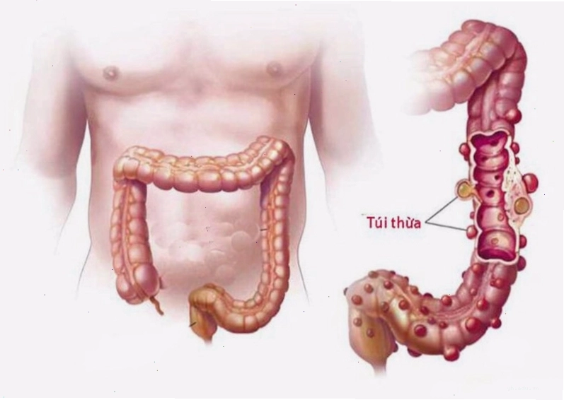 Túi thừa đại tràng dưới góc nhìn y khoa