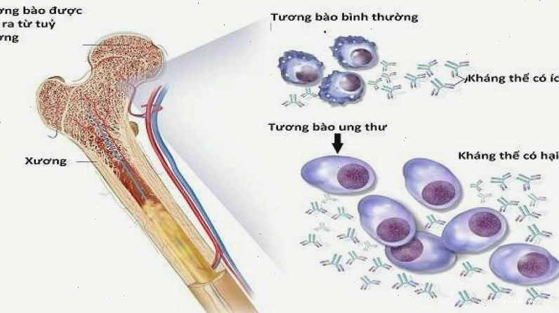 Tương bào tăng sinh bất thường