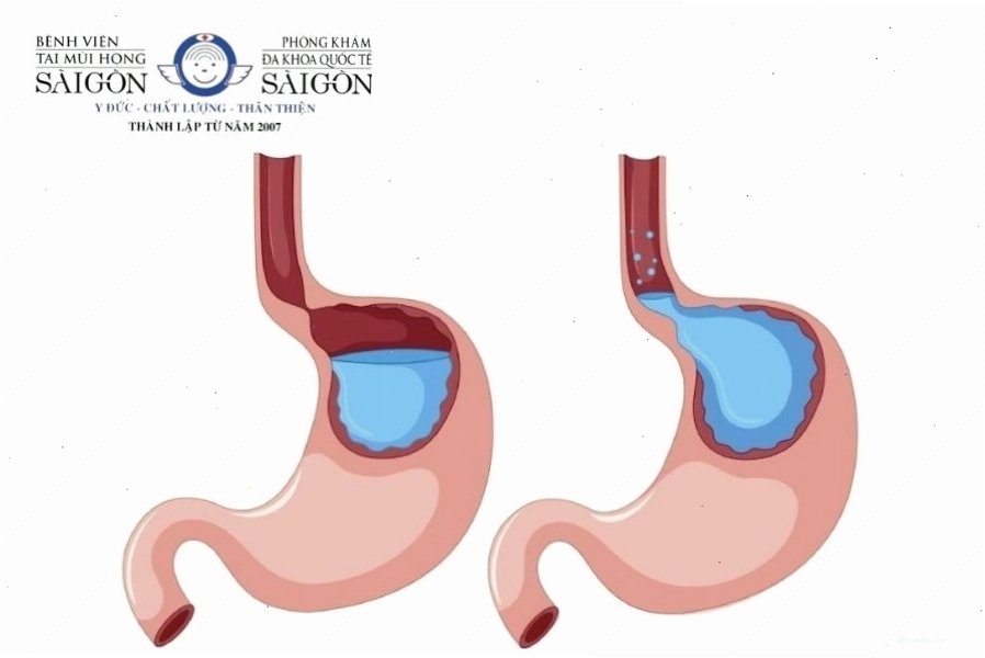 Tuyến nước bọt tiết nhiều có thể do trào ngược dạ dày
