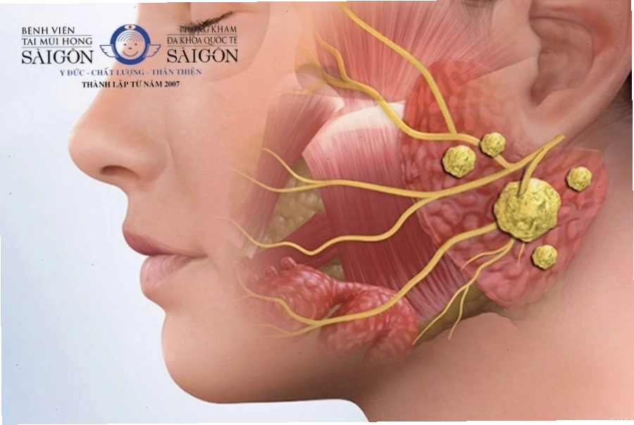 Tuyến nước bọt tiết nhiều do viêm nhiễm