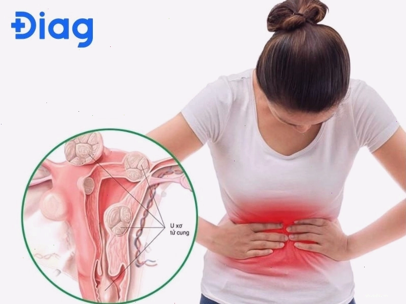 U xơ tử cung gây chảy máu nhiều, kéo dài và xuất hiện ngoài kỳ kinh