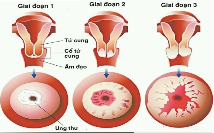 Ung thư cổ tử cung là loại bệnh lý phổ biến hiện nay