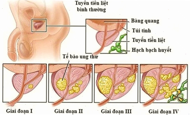 Ung thư tuyến tiền liệt gây xuất tinh ra máu