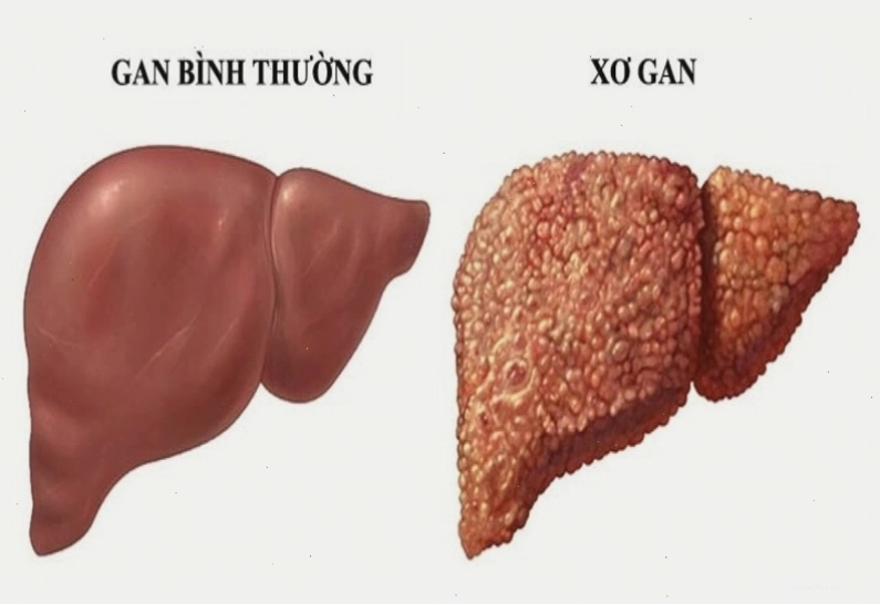 Vàng da do các bệnh lý gan mật
