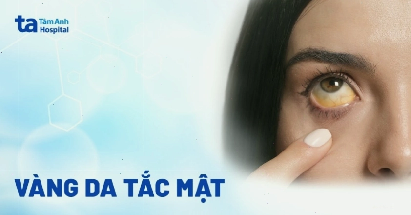 Vàng da tắc mật