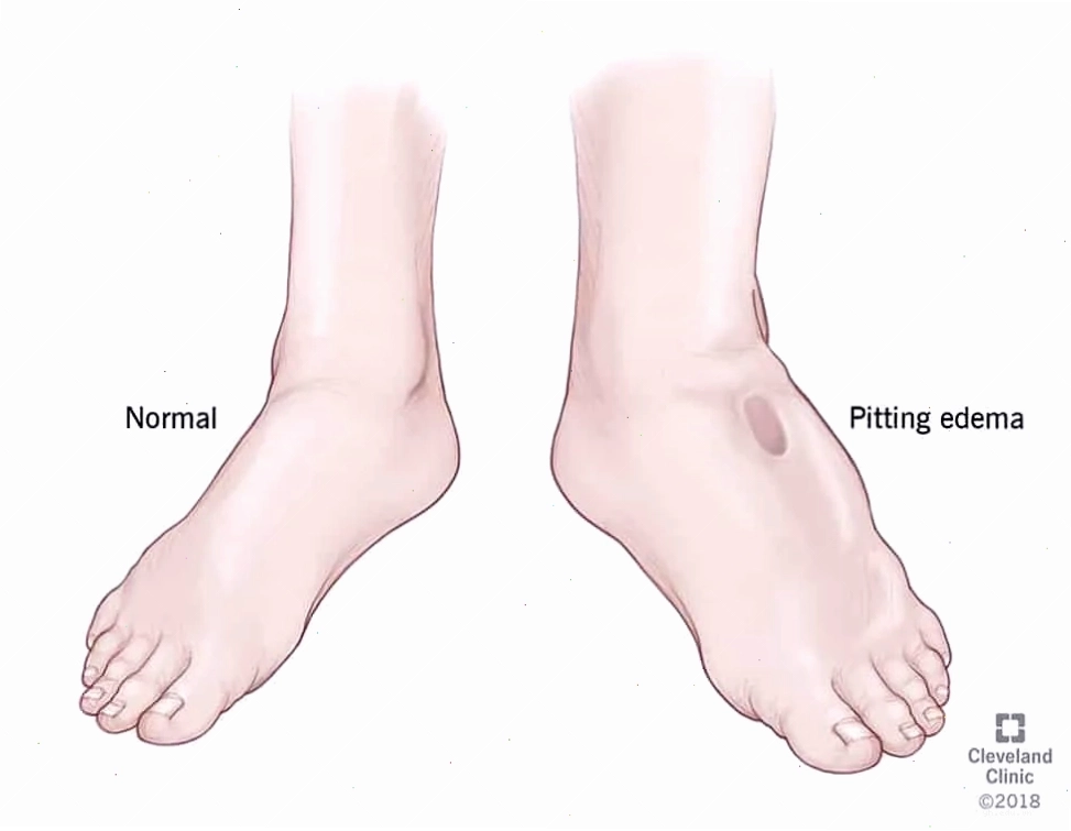 Vết ấn lõm khi da bị phù thũng