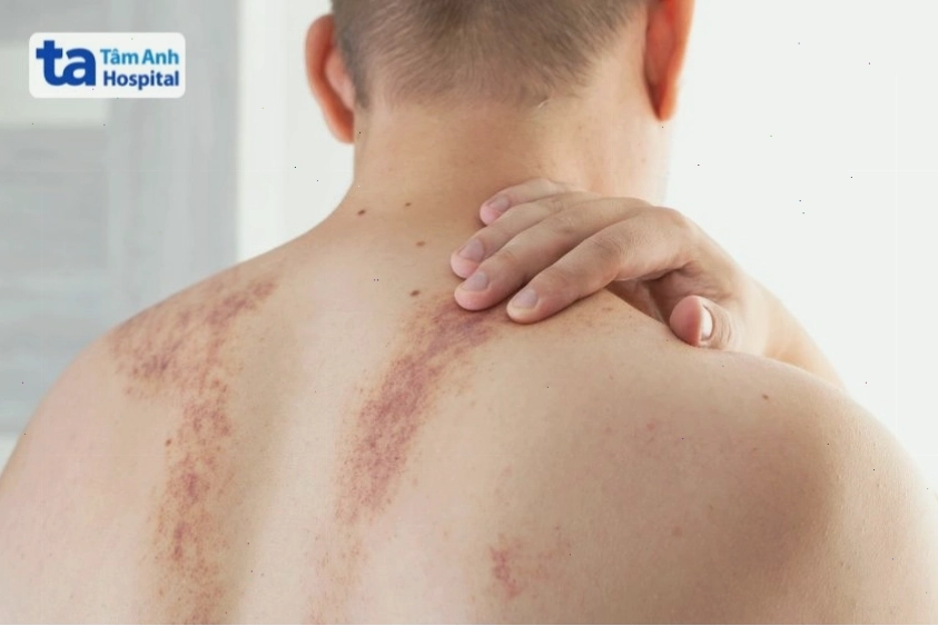 Vết bầm lớn ở lưng