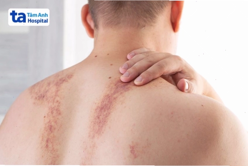 Vết bầm ở lưng