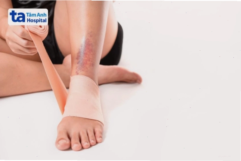 Vết bầm sau khi bị chấn thương chân
