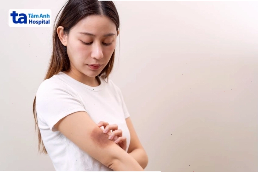 Vết bầm trên cánh tay