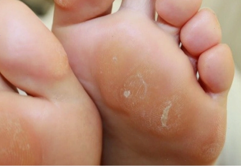 Vết chai chân thường không nguy hiểm nhưng gây phiền toái