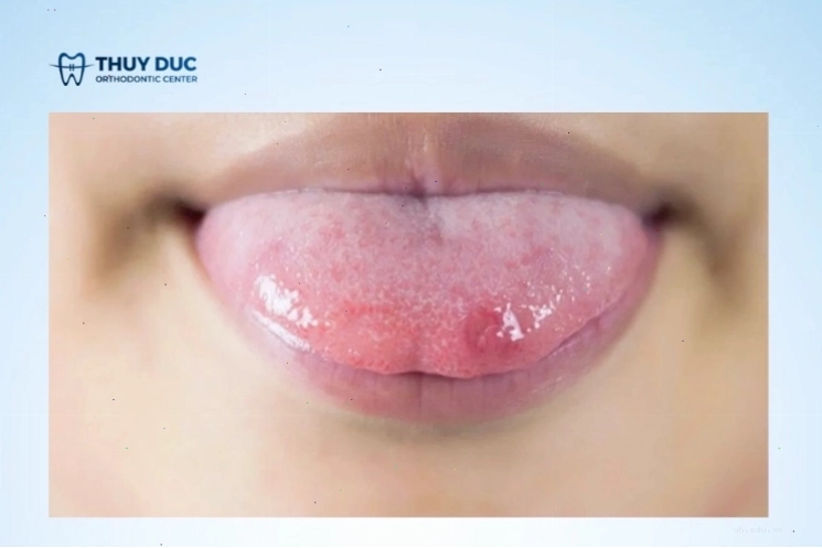 Vết nhiệt lưỡi do cắn phải