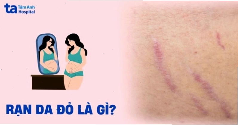 Vết rạn da đỏ cảnh báo tình trạng viêm hoặc tổn thương mạch máu dưới da