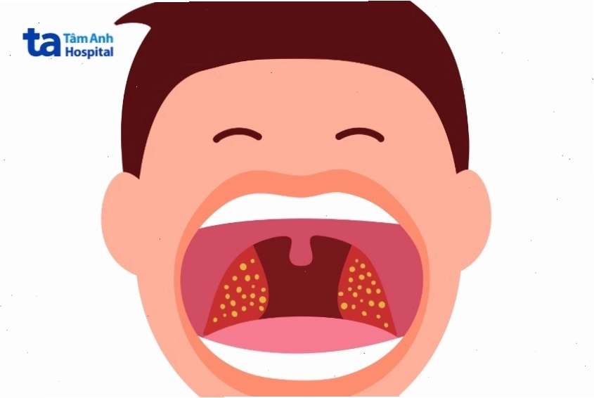 Vi khuẩn bạch hầu gây nhiễm trùng hô hấp cấp tính