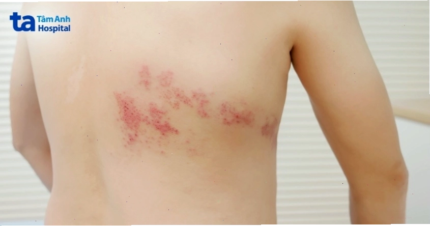 Vị trí thường phát triển bệnh giời leo trên cơ thể
