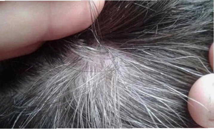 Vị trí tóc bạc xuất hiện nhiều thể hiện vấn đề liên quan đến sức khỏe của bạn