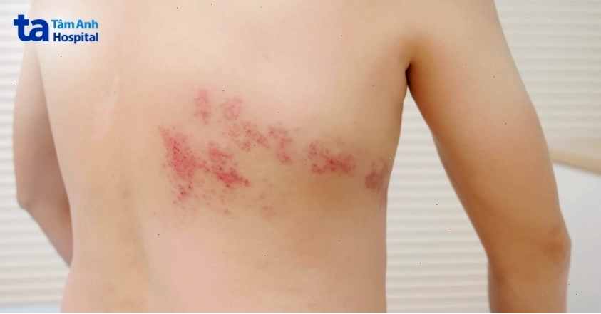 Vị trí virus gây bệnh giời leo thường khu trú và phát triển