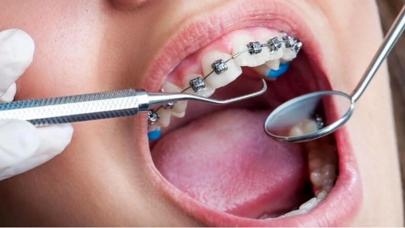 Việc niềng răng không khớp có thể làm tăng nguy cơ tổn thương quanh khóe miệng