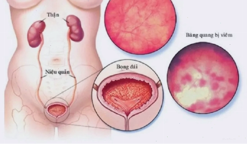 Viêm bàng quang kẽ là tình trạng lớp niêm mạc của bàng quang bị tổn thương gây viêm