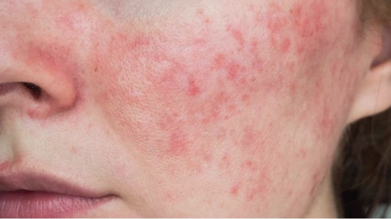 Viêm da dị ứng gây tê mặt