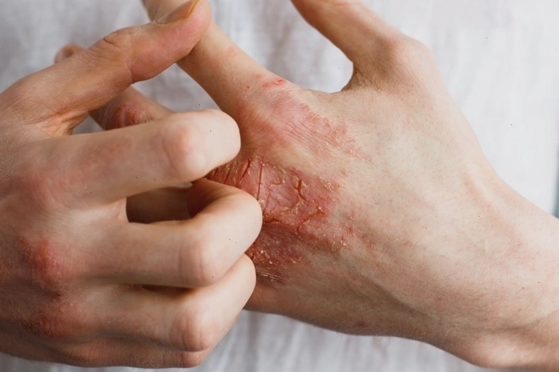 Viêm da tiếp xúc gây bong tróc