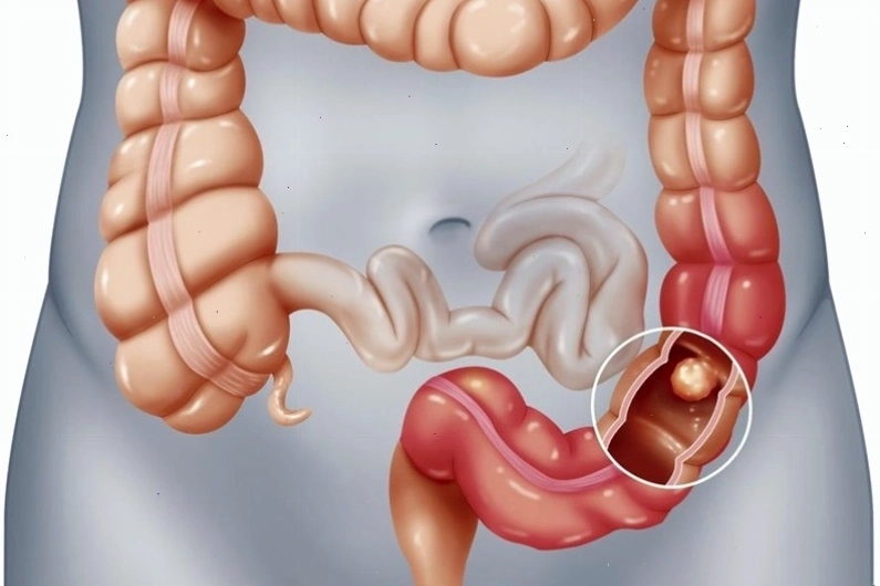 Viêm đại tràng có thể là một trong những nguyên nhân gây chảy máu hậu môn