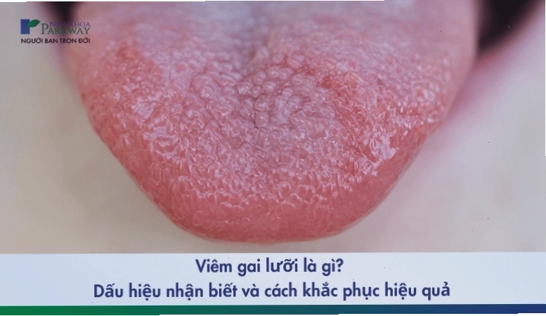 Viêm gai lưỡi là gì và những cách khắc phục