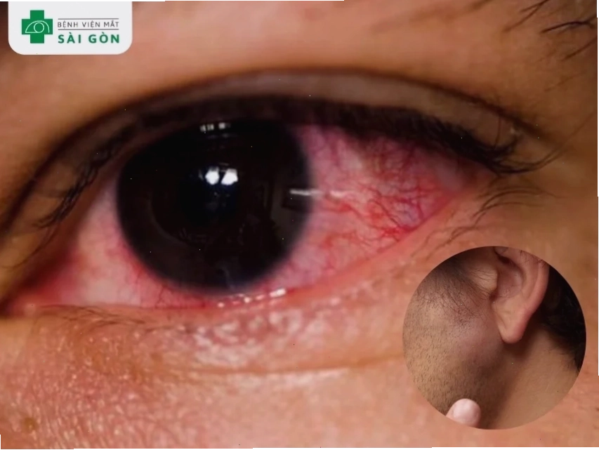 Viêm kết mạc do virus gây hạch