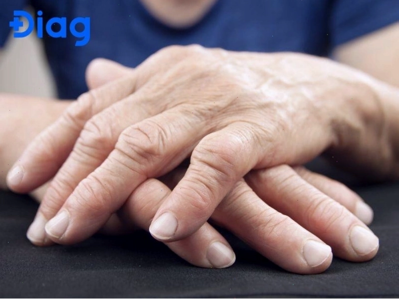 Viêm khớp dạng thấp gây khó khăn trong vận động