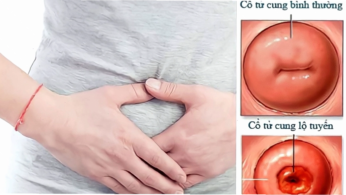 Viêm lộ tuyến cổ tử cung