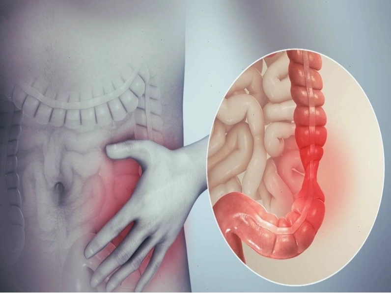 Viêm loét đại tràng là một bệnh lý quan trọng cần can thiệp ngoại khoa