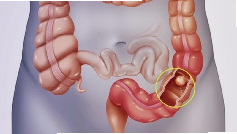 Viêm loét trực tràng gây ra triệu chứng mót rặn