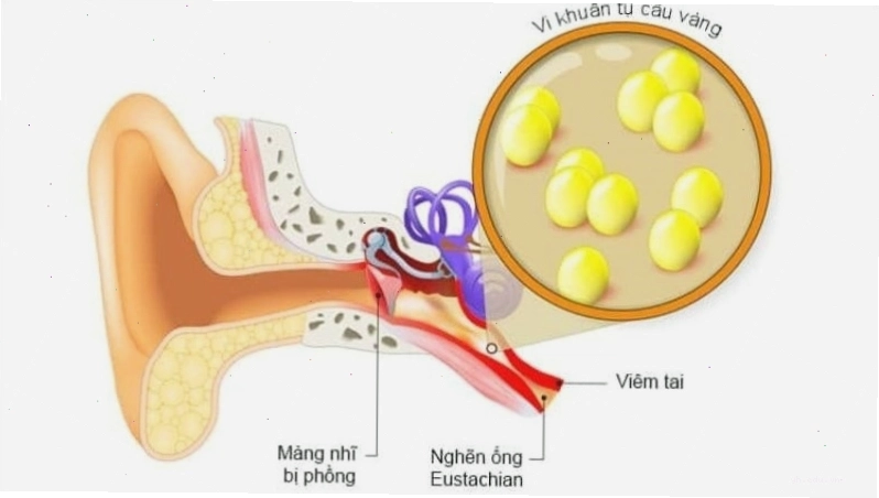 Viêm mê nhĩ gây nên tình trạng rối loạn hoạt động cơ quan thăng bằng của cơ thể