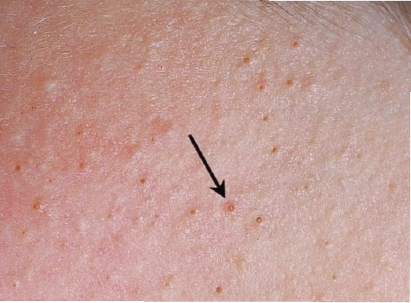 Viêm nang lông là một nguyên nhân phổ biến gây mụn bìu