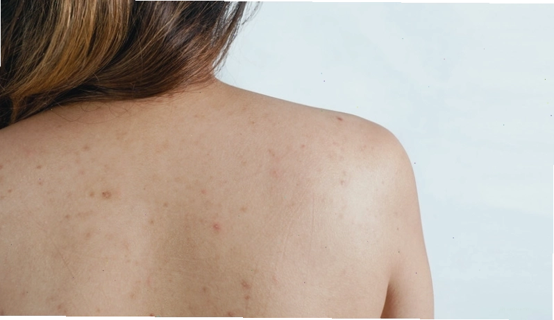 Viêm nang lông vùng lưng thường khó vệ sinh sạch sẽ