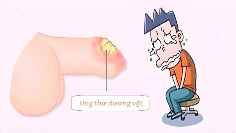 Viêm nhiễm lâu ngày có thể là dấu hiệu tiền thân của ung thư dương vật