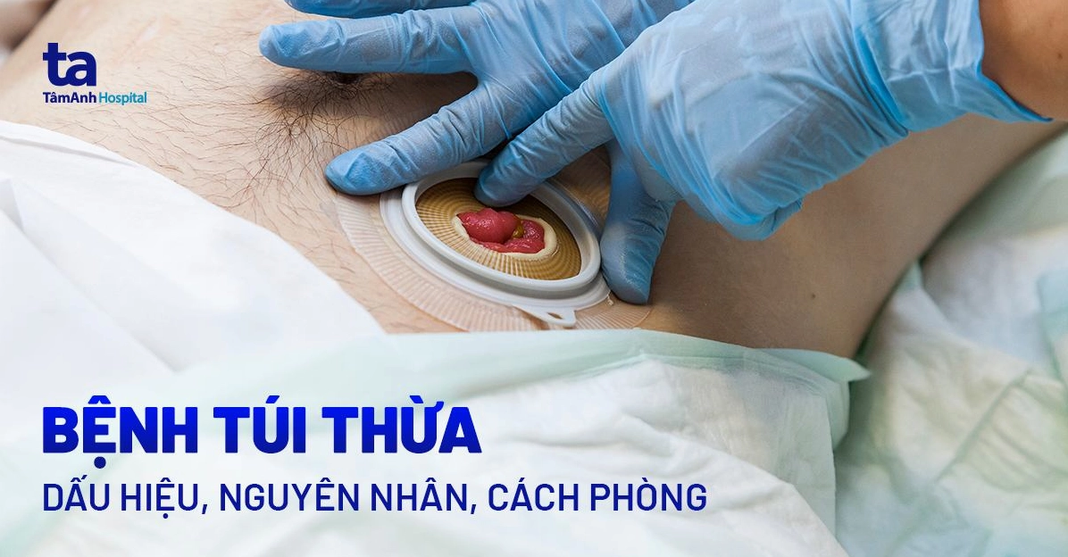 Viêm túi thừa là bệnh gì và những điều cần biết để bảo vệ sức khỏe