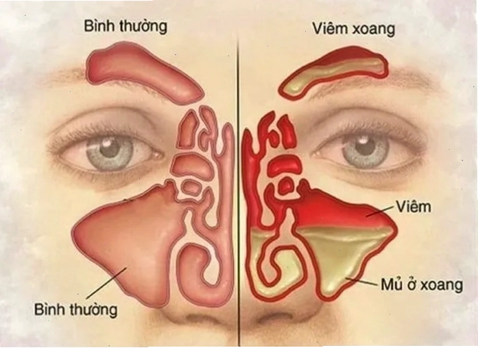 Viêm xoang làm cản trở đường thở và gây mất mùi vị