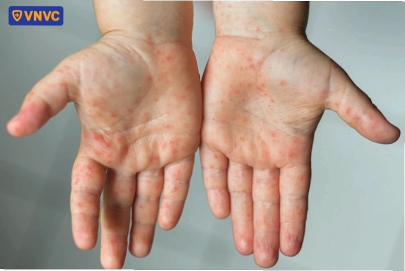 Virus tay chân miệng có khả năng tồn tại trên bề mặt khô cứng