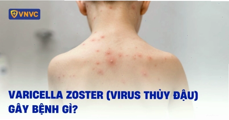 Virus Varicella Zoster gây bệnh thủy đậu