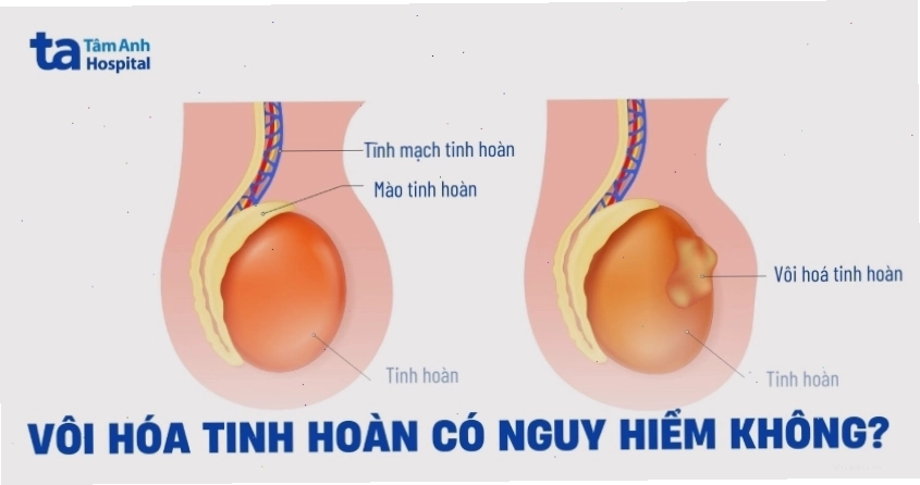 Vôi hóa tinh hoàn và các bệnh lý liên quan