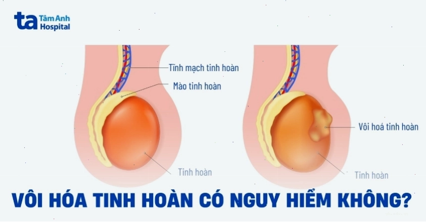 Vôi hóa tinh hoàn và các vấn đề sức khỏe nam giới