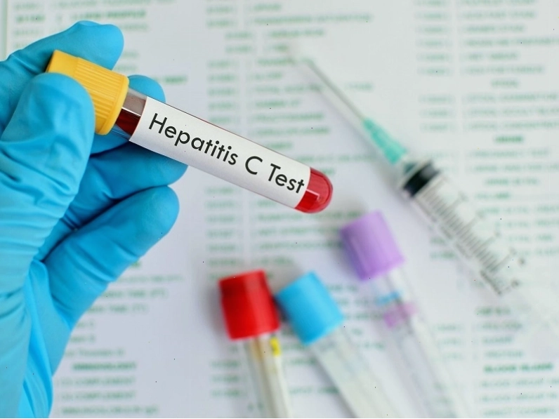 Xét nghiệm anti HCV trên mẫu bệnh phẩm giúp tìm ra sự hiện diện của virus gây viêm gan C