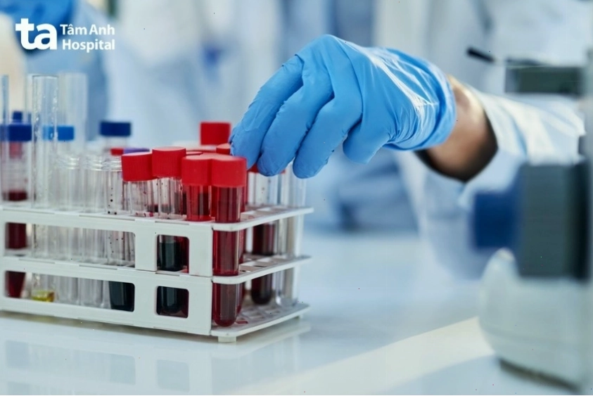 Xét nghiệm máu chẩn đoán cường giáp tại bệnh viện