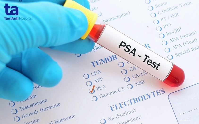 Xét nghiệm PSA đánh giá sức khỏe tuyến tiền liệt