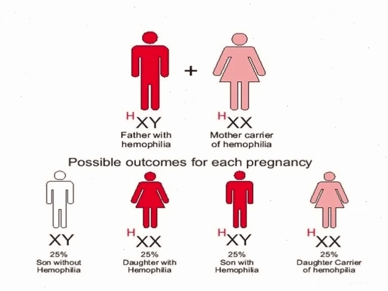 Yếu tố di truyền là nguyên nhân hàng đầu của bệnh Hemophilia