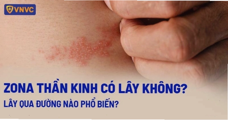Zona thần kinh có lây lan không